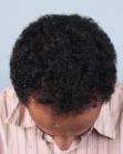 After Hair Transplant&nbsp;Hairlines